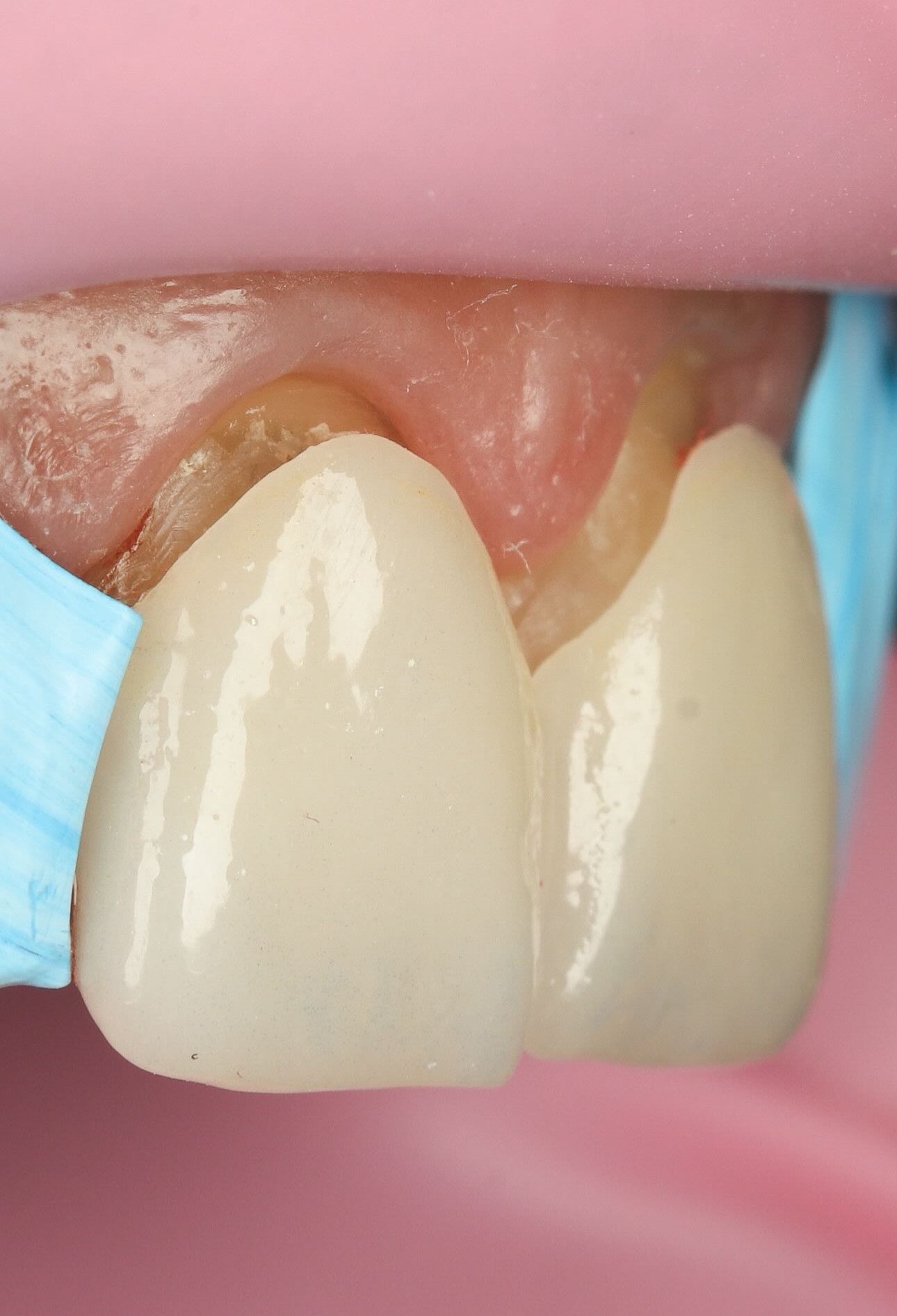 Resultado carillas 3